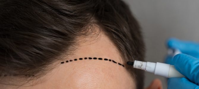 Naturligt fylligare hår med modern transplantation i Göteborg Naturligt fylligare hår med modern transplantation i Göteborg